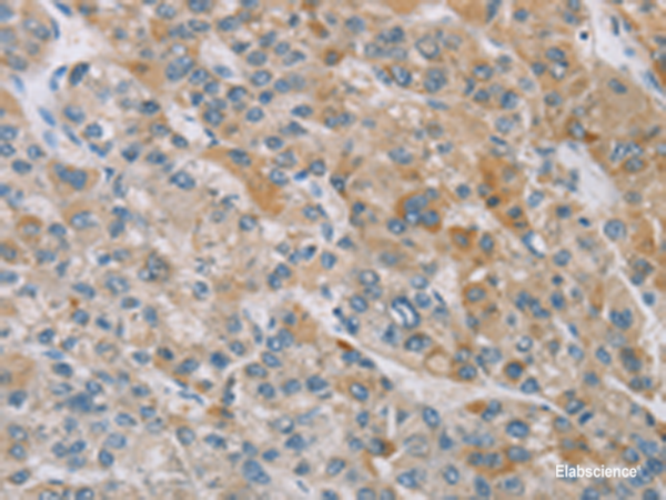 Immunohistochemistry of paraffin-embedded Human liver cancer tissue using ZAK Polyclonal Antibody at dilution of 1:100(×200)