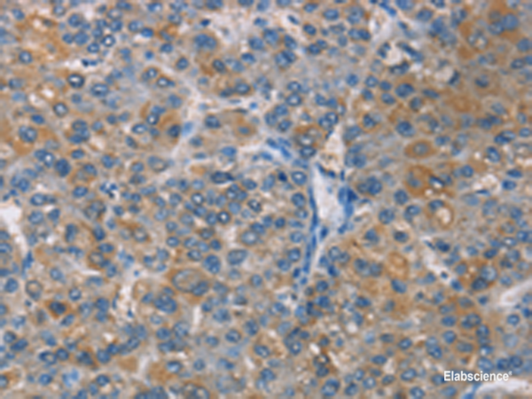 Immunohistochemistry of paraffin-embedded Human liver cancer tissue using ZBTB1 Polyclonal Antibody at dilution of 1:50(×200)