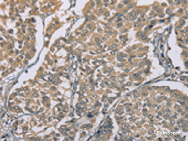 Immunohistochemistry of paraffin-embedded Human breast cancer tissue using ZBTB2 Polyclonal Antibody at dilution of 1:50(×200)