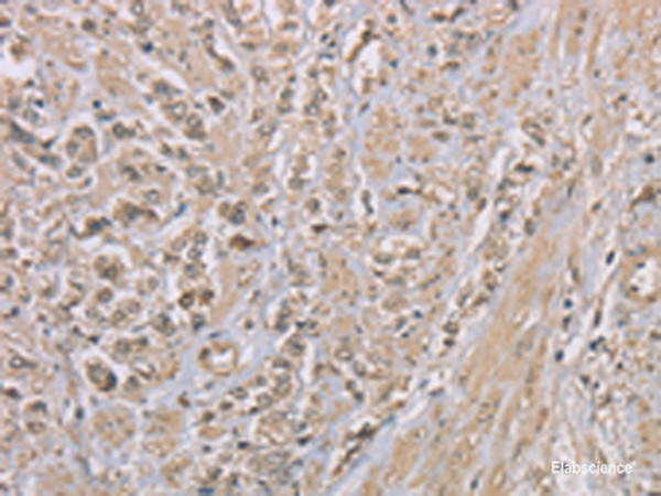 Immunohistochemistry of paraffin-embedded Human prost at e cancer tissue using ZBTB2 Polyclonal Antibody at dilution of 1:50(×200)