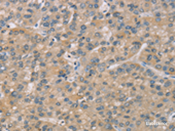 Immunohistochemistry of paraffin-embedded Human liver cancer tissue using ZBTB3 Polyclonal Antibody at dilution of 1:50(×200)