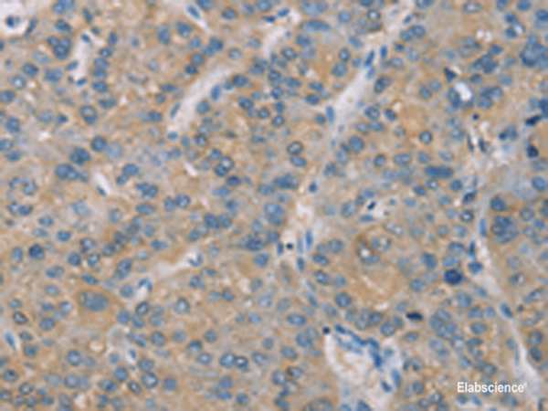 Immunohistochemistry of paraffin-embedded Human liver cancer tissue using ZBTB6 Polyclonal Antibody at dilution of 1:50(×200)