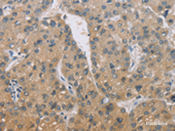 Immunohistochemistry of paraffin-embedded Human liver cancer tissue using ZBTB6 Polyclonal Antibody at dilution of 1:50(×200)