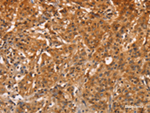 Immunohistochemistry of paraffin-embedded Human gastric cancer tissue using ZFP64 Polyclonal Antibody at dilution of 1:60(×200)