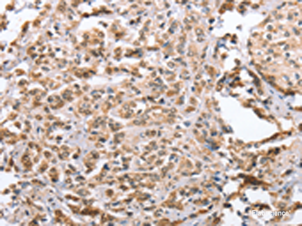 Immunohistochemistry of paraffin-embedded Human prost at e cancer tissue using ZFYVE16 Polyclonal Antibody at dilution of 1:60(×200)