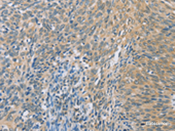 Immunohistochemistry of paraffin-embedded Human cervical cancer tissue using ZHX3 Polyclonal Antibody at dilution of 1:100(×200)