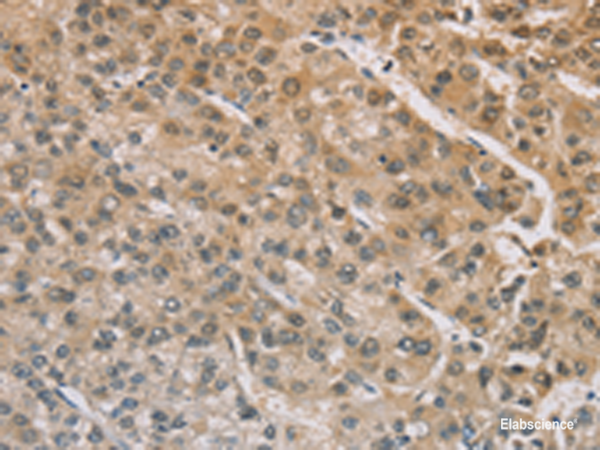 Immunohistochemistry of paraffin-embedded Human liver cancer tissue using ZIC2 Polyclonal Antibody at dilution of 1:100(×200)