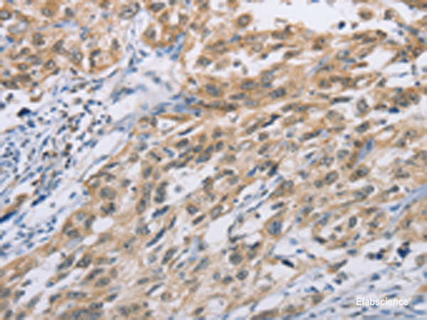 Immunohistochemistry of paraffin-embedded Human esophagus cancer tissue using ZIC5 Polyclonal Antibody at dilution of 1:100(×200)