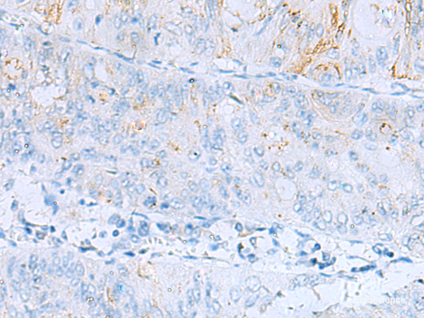 Immunohistochemistry of paraffin-embedded Human colorectal cancer tissue using ERBB2 Polyclonal Antibody at dilution of 1:60(×200)