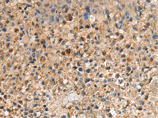 Immunohistochemistry of paraffin-embedded Human liver cancer tissue using CXCR5 Polyclonal Antibody at dilution of 1:60(×200)
