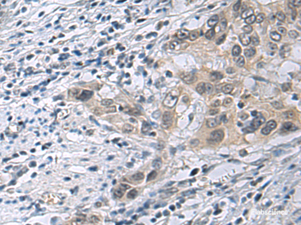 Immunohistochemistry of paraffin-embedded Human esophagus cancer tissue using IRS4 Polyclonal Antibody at dilution of 1:45(×200)