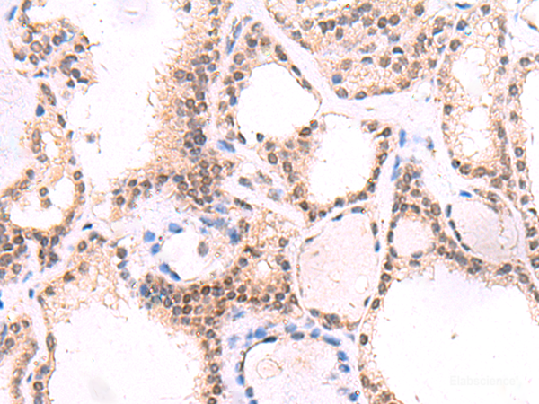 Immunohistochemistry of paraffin-embedded Human thyroid cancer tissue using MYOD1 Polyclonal Antibody at dilution of 1:50(×200)