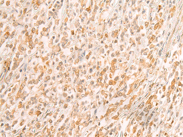 Immunohistochemistry of paraffin-embedded Human gastric cancer tissue using SREBF2 Polyclonal Antibody at dilution of 1:50(×200)
