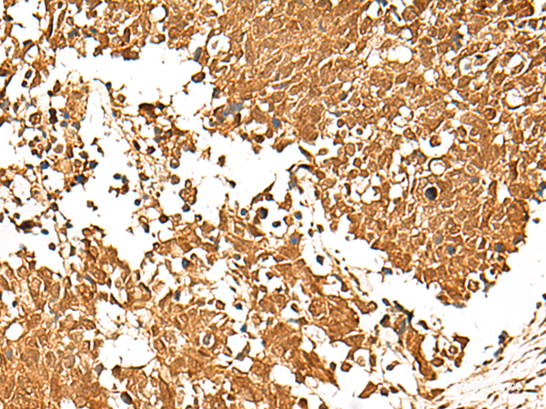 Immunohistochemistry of paraffin-embedded Human lung cancer tissue using TCF7 Polyclonal Antibody at dilution of 1:30(×200)