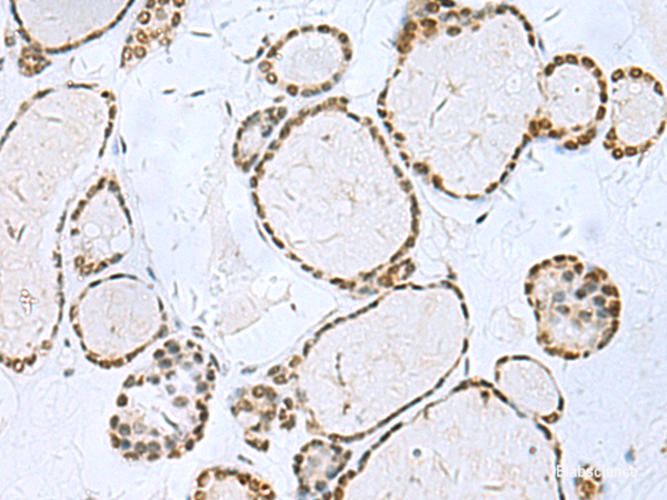 Immunohistochemistry of paraffin-embedded Human thyroid cancer tissue using TH Polyclonal Antibody at dilution of 1:40(×200)