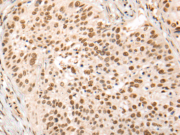 Immunohistochemistry of paraffin-embedded Human lung cancer tissue using HOXA7 Polyclonal Antibody at dilution of 1:70(×200)