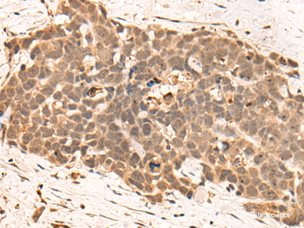 Immunohistochemistry of paraffin-embedded Human thyroid cancer tissue using CLK2 Polyclonal Antibody at dilution of 1:45(×200)
