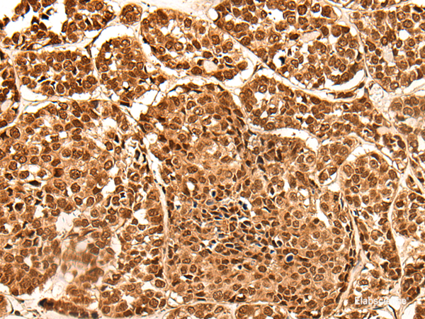 Immunohistochemistry of paraffin-embedded Human esophagus cancer tissue using NEK7 Polyclonal Antibody at dilution of 1:60(×200)
