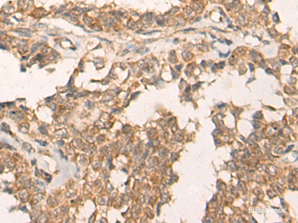 Immunohistochemistry of paraffin-embedded Human ovarian cancer tissue using ATR Polyclonal Antibody at dilution of 1:60(×200)