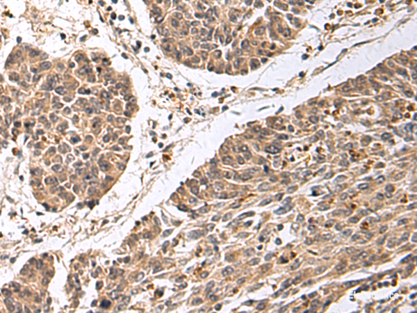 Immunohistochemistry of paraffin-embedded Human colorectal cancer tissue using CD24 Polyclonal Antibody at dilution of 1:25(×200)