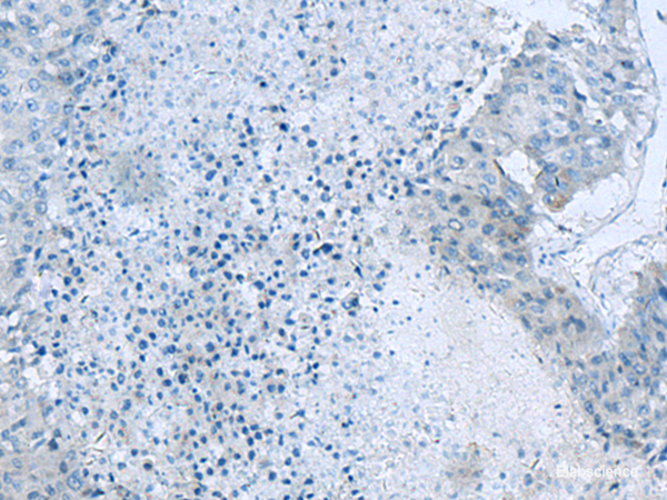 Immunohistochemistry of paraffin-embedded Human liver cancer tissue using GLS Polyclonal Antibody at dilution of 1:60(×200)