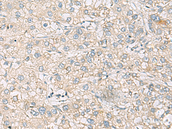 Immunohistochemistry of paraffin-embedded Human liver cancer tissue using RAC2 Polyclonal Antibody at dilution of 1:60(×200)
