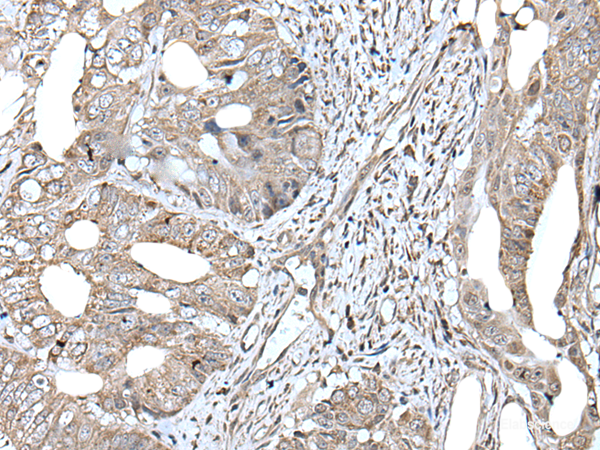 Immunohistochemistry of paraffin-embedded Human colorectal cancer tissue using RAD54B Polyclonal Antibody at dilution of 1:45(×200)