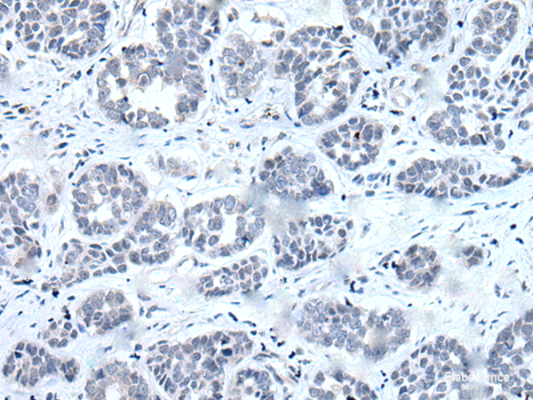 Immunohistochemistry of paraffin-embedded Human esophagus cancer tissue using RARG Polyclonal Antibody at dilution of 1:55(×200)