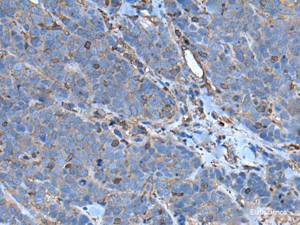 Immunohistochemistry of paraffin-embedded Human thyroid cancer tissue using SLC24A5 Polyclonal Antibody at dilution of 1:50(×200)