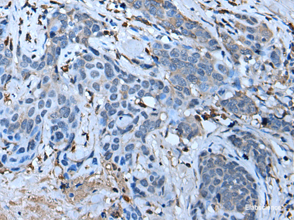 Immunohistochemistry of paraffin-embedded Human thyroid cancer tissue using F3 Polyclonal Antibody at dilution of 1:70(×200)