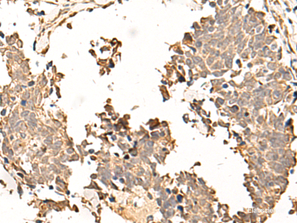Immunohistochemistry of paraffin-embedded Human lung cancer tissue using SOX3 Polyclonal Antibody at dilution of 1:50(×200)