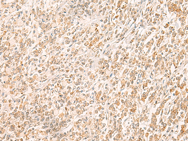 Immunohistochemistry of paraffin-embedded Human gastric cancer tissue using MYCT1 Polyclonal Antibody at dilution of 1:35(×200)