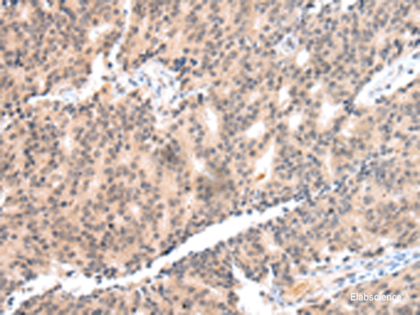 Immunohistochemistry of paraffin-embedded Human prost at e cancer tissue using COX17 Polyclonal Antibody at dilution of 1:55(×200)