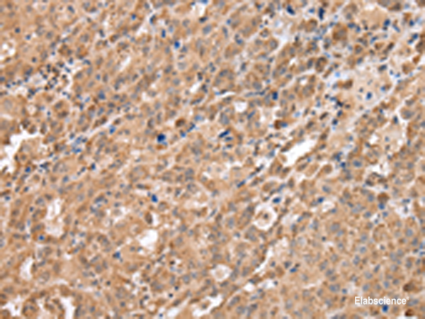 Immunohistochemistry of paraffin-embedded Human ovarian cancer tissue using DDX58 Polyclonal Antibody at dilution of 1:40(×200)