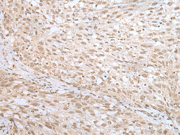 Immunohistochemistry of paraffin-embedded Human lung cancer tissue using MORF4L1 Polyclonal Antibody at dilution of 1:45(×200)