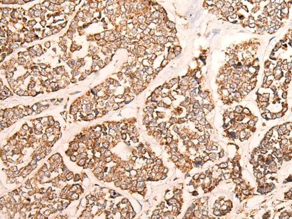 Immunohistochemistry of paraffin-embedded Human esophagus cancer tissue using GRIA4 Polyclonal Antibody at dilution of 1:40(×200)