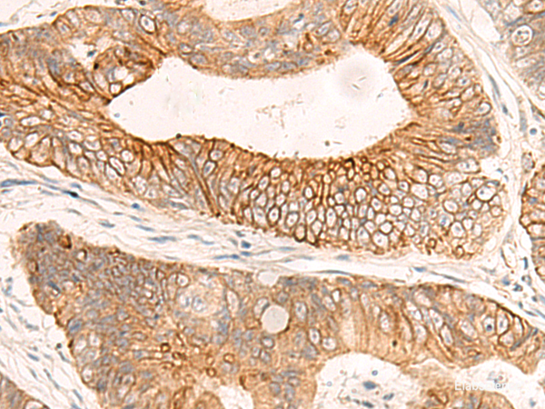 Immunohistochemistry of paraffin-embedded Human colorectal cancer tissue using ABHD2 Polyclonal Antibody at dilution of 1:50(×200)