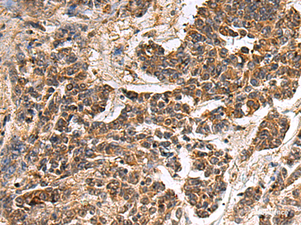 Immunohistochemistry of paraffin-embedded Human colorectal cancer tissue using GANAB Polyclonal Antibody at dilution of 1:30(×200)
