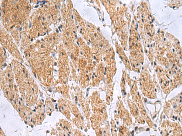 Immunohistochemistry of paraffin-embedded Human esophagus cancer tissue using SLC4A3 Polyclonal Antibody at dilution of 1:35(×200)