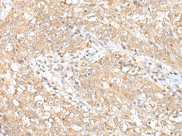 Immunohistochemistry of paraffin-embedded Human esophagus cancer tissue using CHRNB2 Polyclonal Antibody at dilution of 1:50(×200)