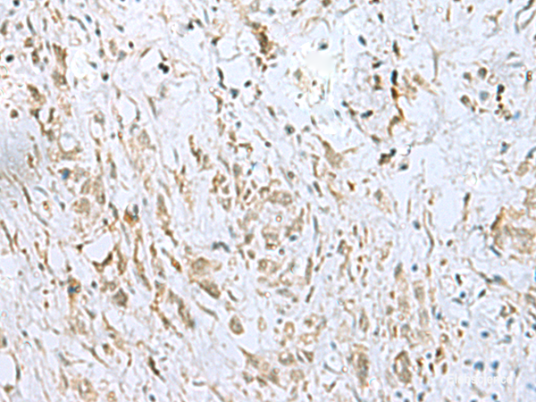 Immunohistochemistry of paraffin-embedded Human gastric cancer tissue using ECT2 Polyclonal Antibody at dilution of 1:35(×200)