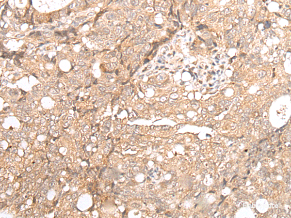 Immunohistochemistry of paraffin-embedded Human gastric cancer tissue using FOXO4 Polyclonal Antibody at dilution of 1:70(×200)