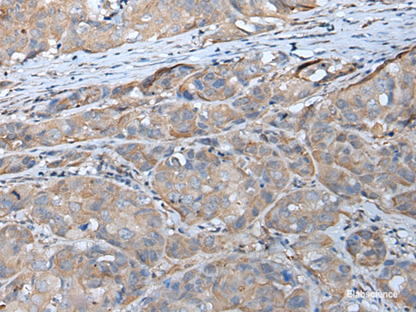 Immunohistochemistry of paraffin-embedded Human breast cancer tissue using GPC5 Polyclonal Antibody at dilution of 1:40(×200)