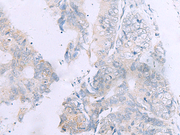 Immunohistochemistry of paraffin-embedded Human colorectal cancer tissue using GPC3 Polyclonal Antibody at dilution of 1:60(×200)