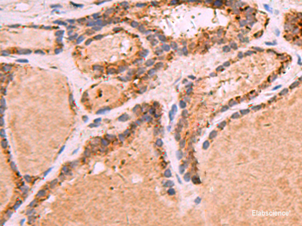 Immunohistochemistry of paraffin-embedded Human thyroid cancer tissue using GPC2 Polyclonal Antibody at dilution of 1:35(×200)