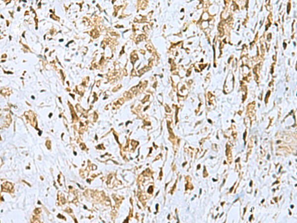 Immunohistochemistry of paraffin-embedded Human gastric cancer tissue using HOXC9 Polyclonal Antibody at dilution of 1:110(×200)