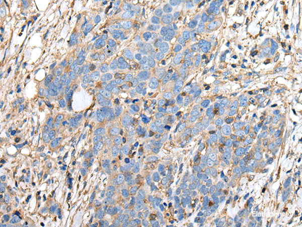 Immunohistochemistry of paraffin-embedded Human thyroid cancer tissue using PLA2G16 Polyclonal Antibody at dilution of 1:40(×200)