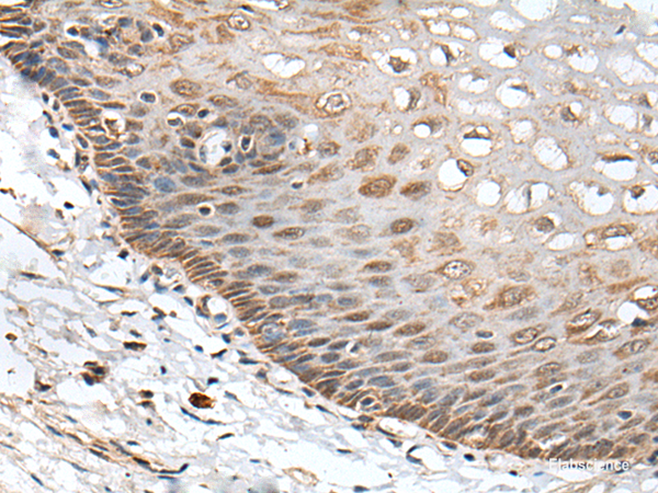 Immunohistochemistry of paraffin-embedded Human esophagus cancer tissue using CHRNA5 Polyclonal Antibody at dilution of 1:50(×200)