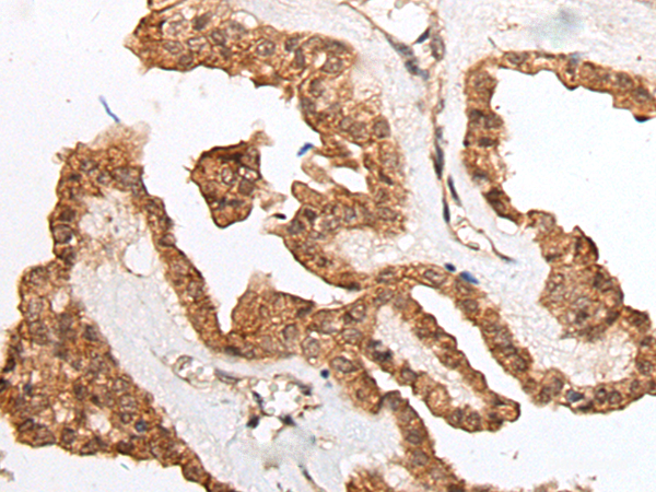 Immunohistochemistry of paraffin-embedded Human thyroid cancer tissue using HOXB9 Polyclonal Antibody at dilution of 1:45(×200)