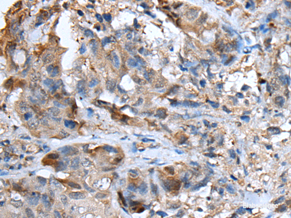 Immunohistochemistry of paraffin-embedded Human breast cancer tissue using CXCL5 Polyclonal Antibody at dilution of 1:50(×200)